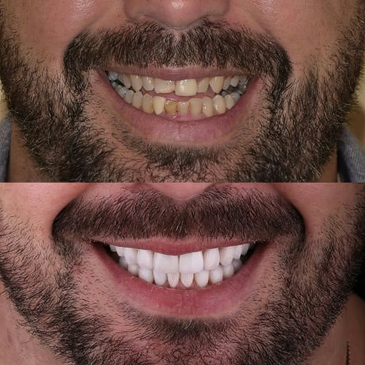 before and after porcelain crowns images