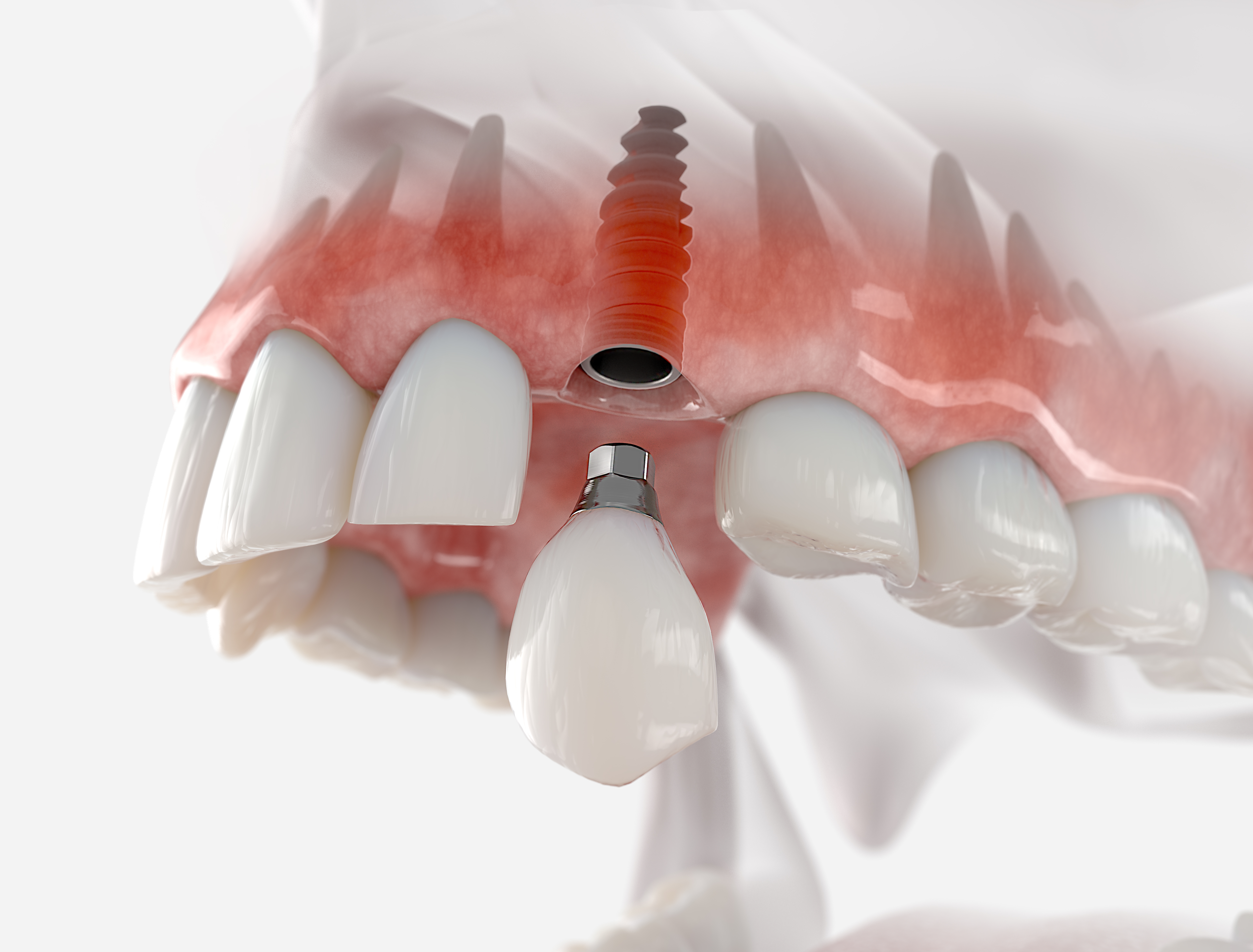 3D rendering of an implant-supported crown