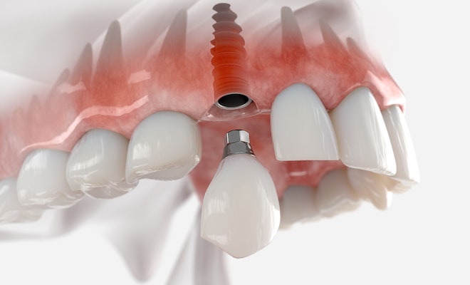 3D rendering of an implant-supported crown