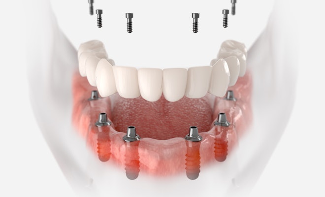 3D rendering of an implant supported denture