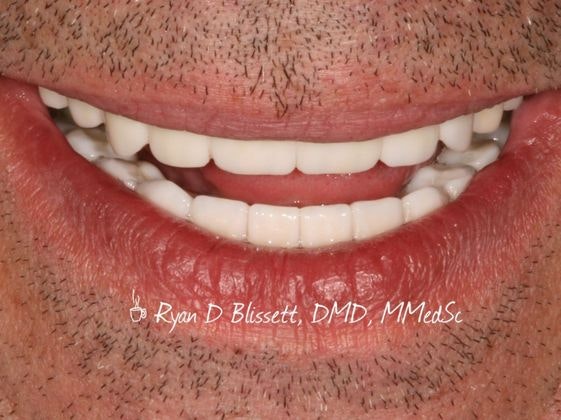 Dr. Ryan Blissett's patient with implant dentures