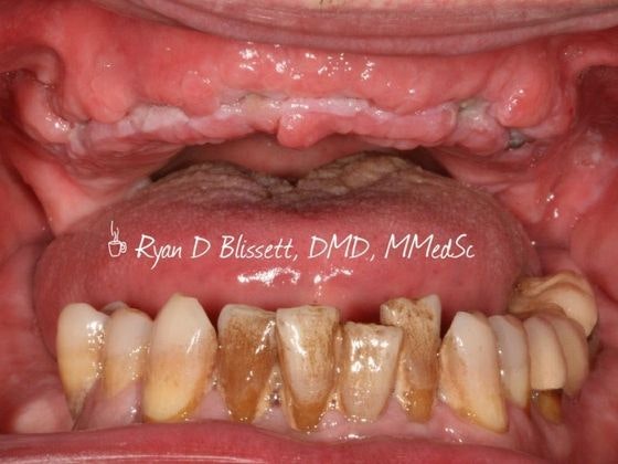 Dr. Ryan Blissett's patient with missing teeth