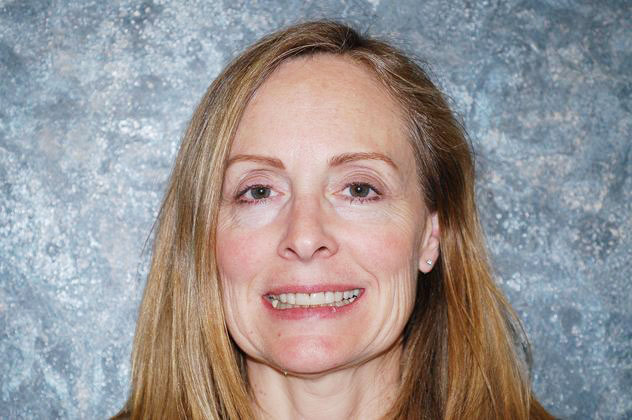 A patient before getting dental crowns