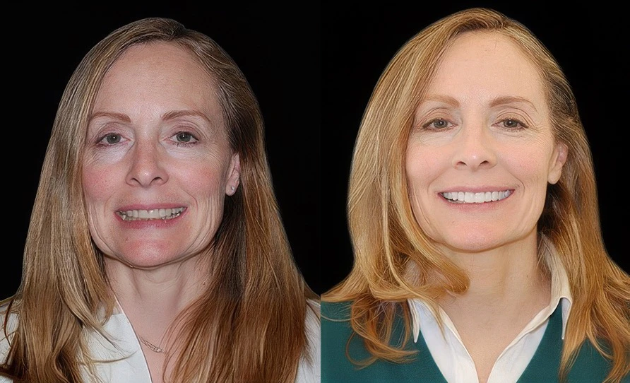 before and after cosmetic dentistry
