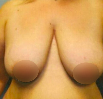 before breast lift