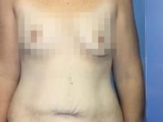 Before mommy makeover