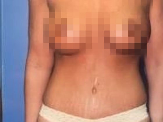 After mommy makeover