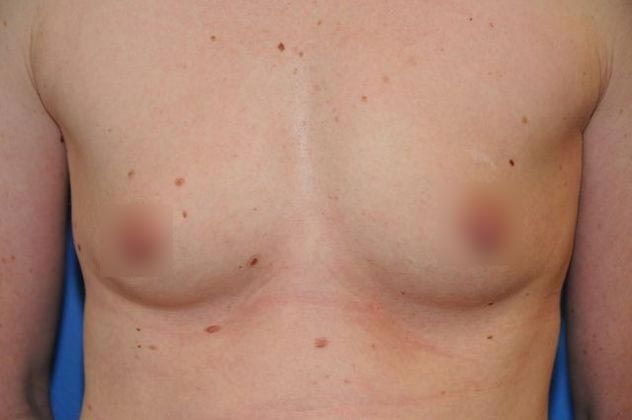 Before breast augmentation