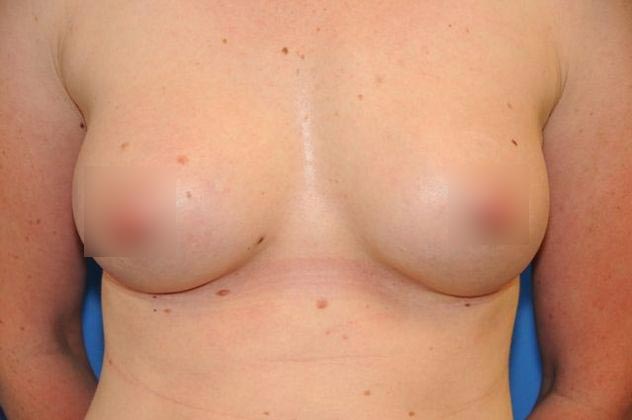 After breast augmentation