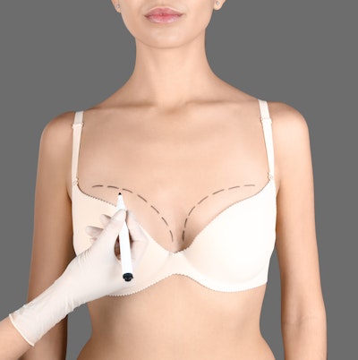 Breast augmentation patient having breasts marked