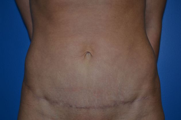 After tummy tuck