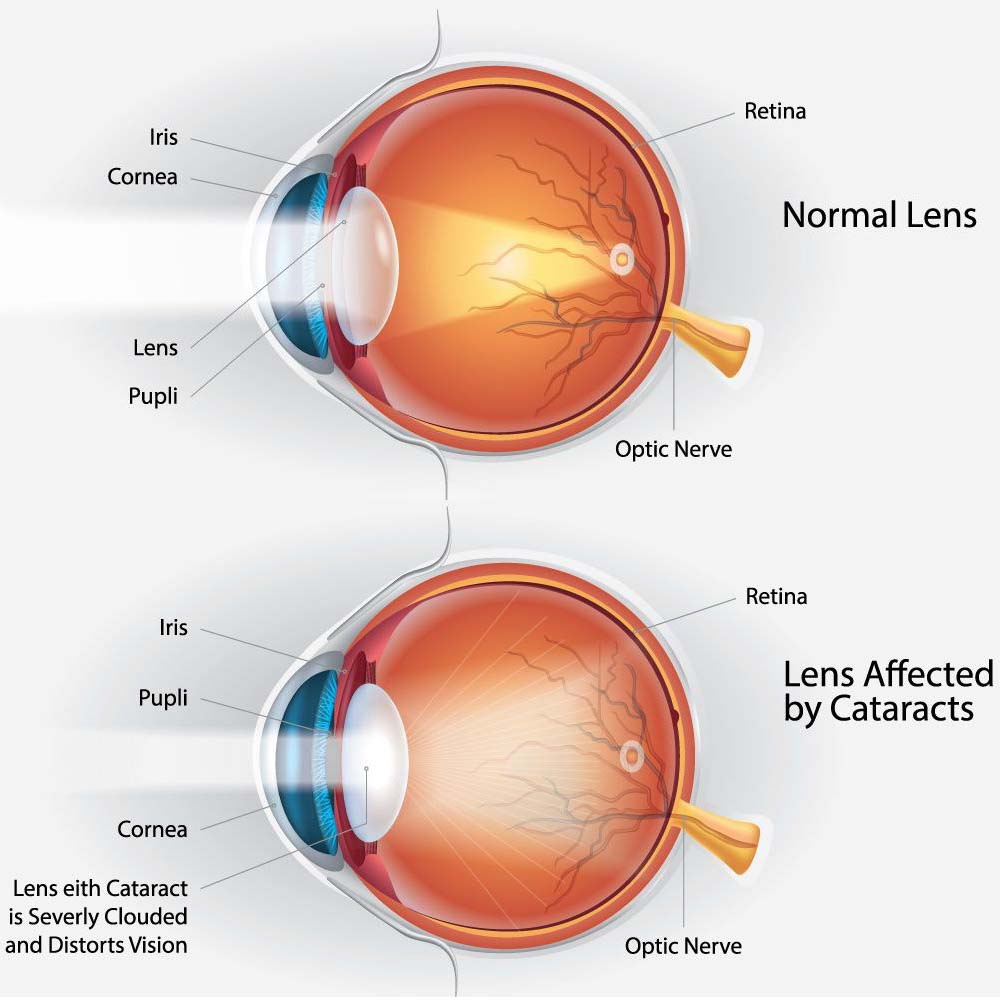 Cataract Surgery Merrillville, IN - Hobart, IN - Deen-Gross Eye Centers