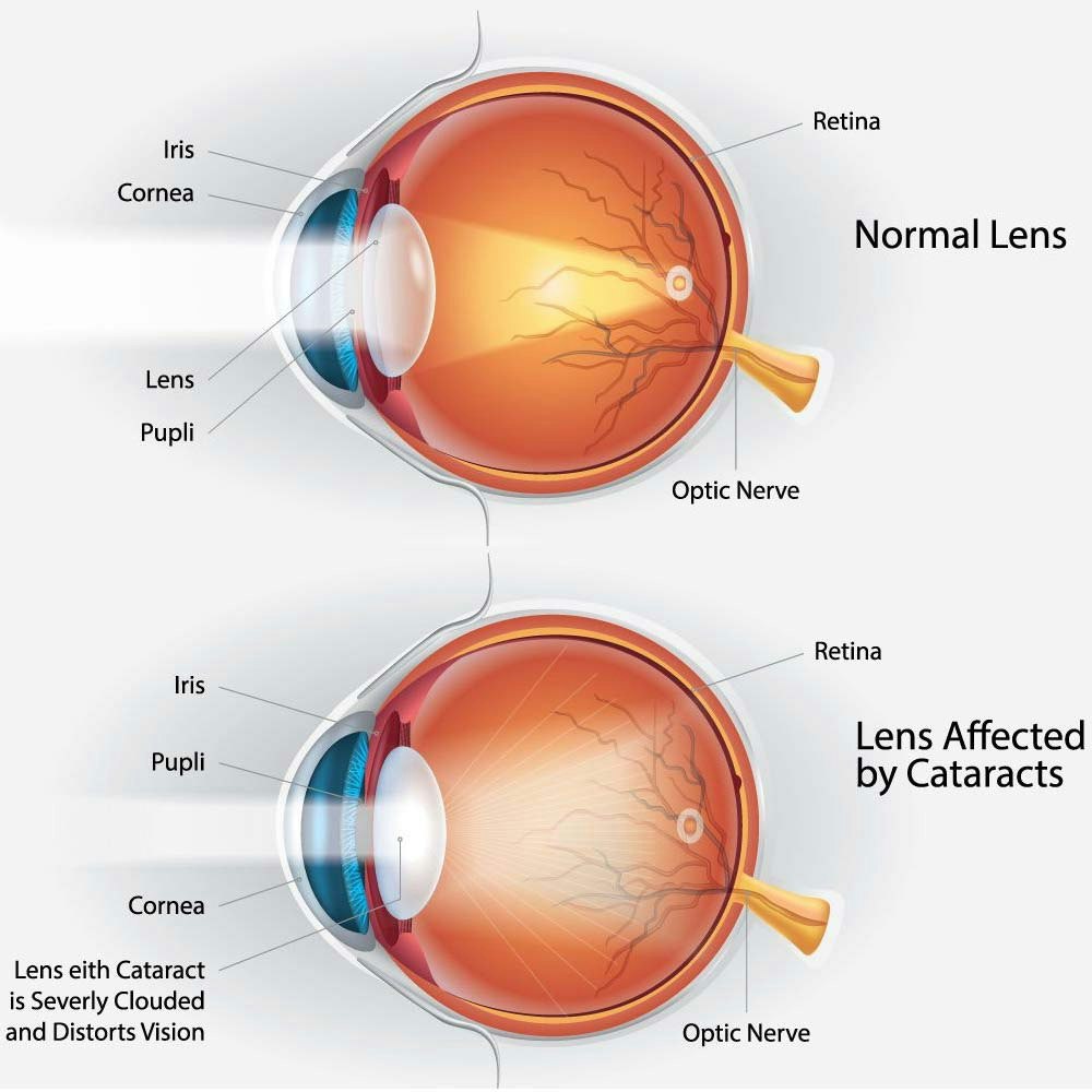 diagram of a normal lens and one affected by cataracts