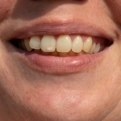 Man with discolored teeth
