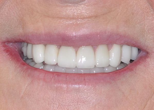 Dr. Brian Bell's Patient After Full Mouth Reconstruction