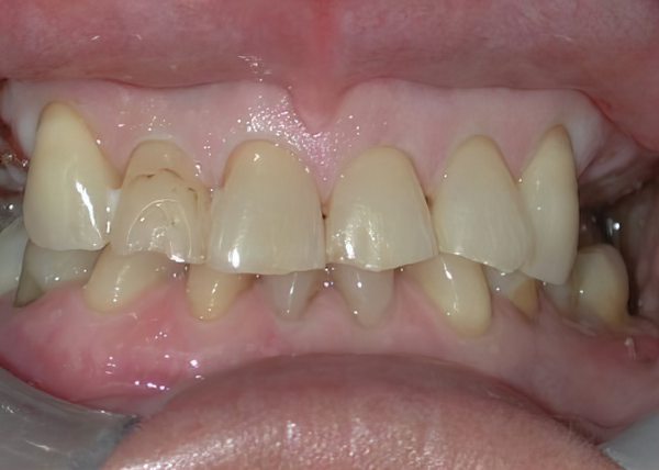 Dr. Brian Bell's Patient Before Full Mouth Reconstruction