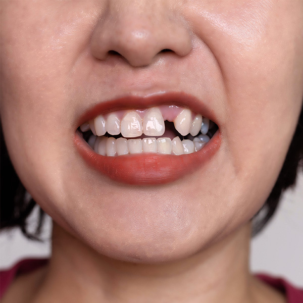 Woman's missing tooth