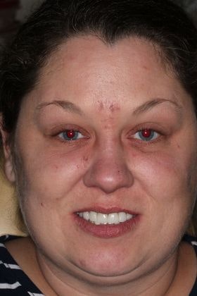 Bell Dental patient after implants