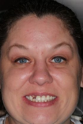 Bell Dental patient before implants