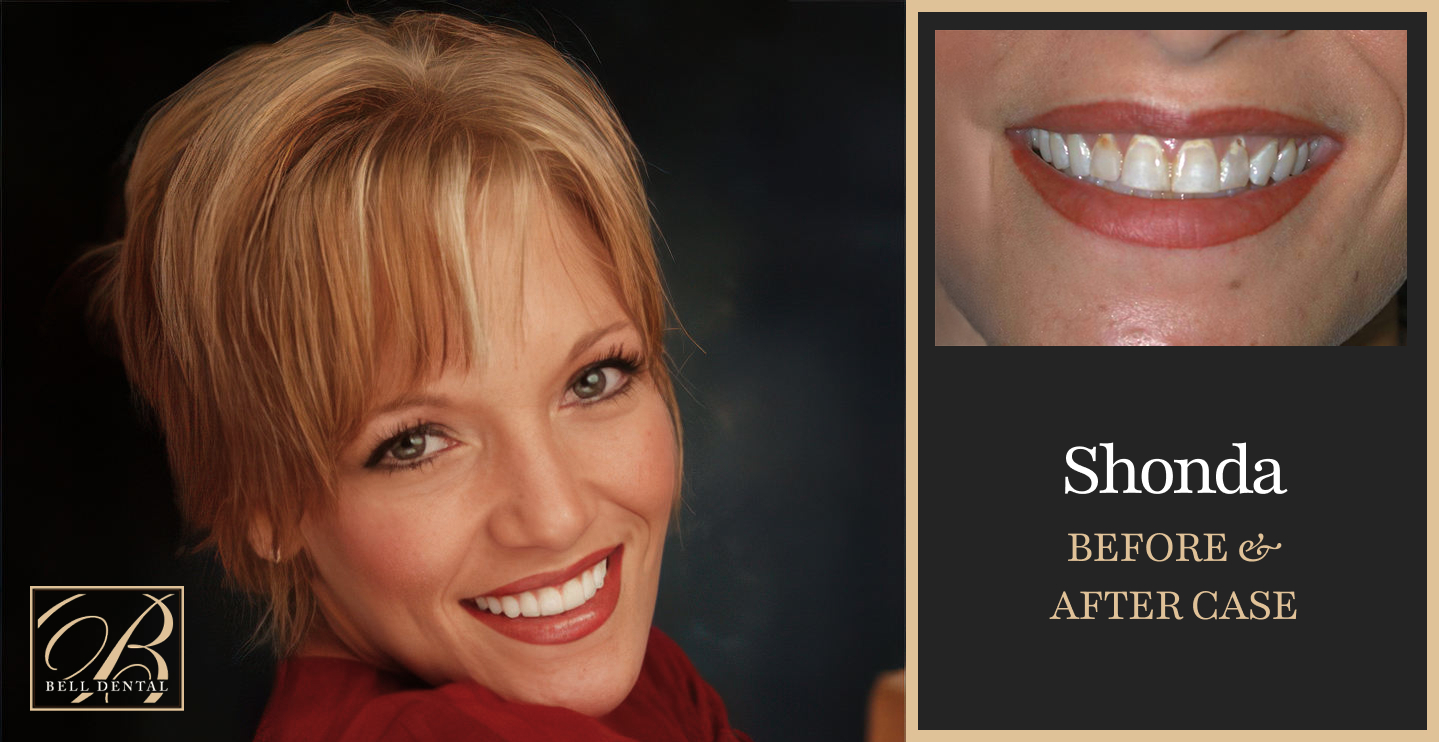 before and after cosmetic dentistry