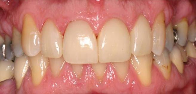 patient after veneers
