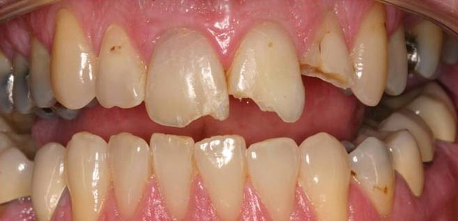 patient before veneers