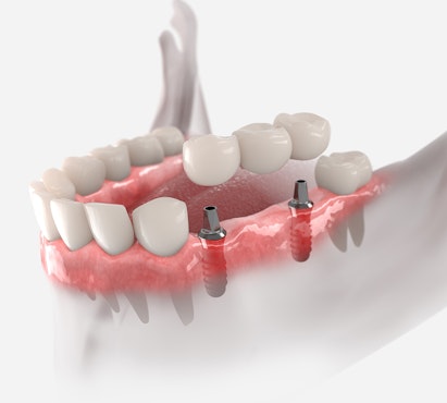 Dental bridge