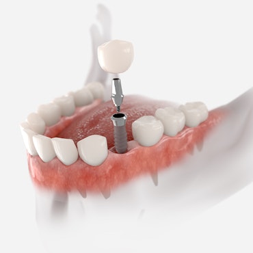 a model of dental implants