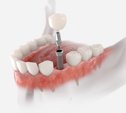 a model of dental implants