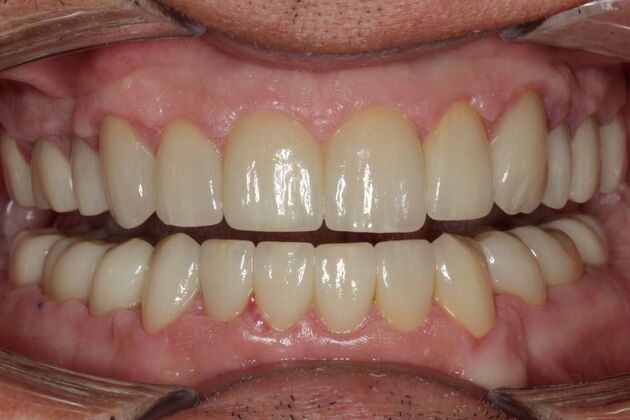 after Full Mouth Rehabilitation dental care