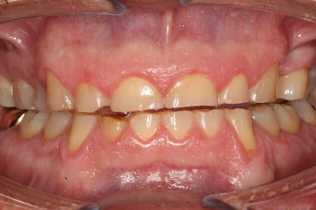 before Full Mouth Rehabilitation dental care