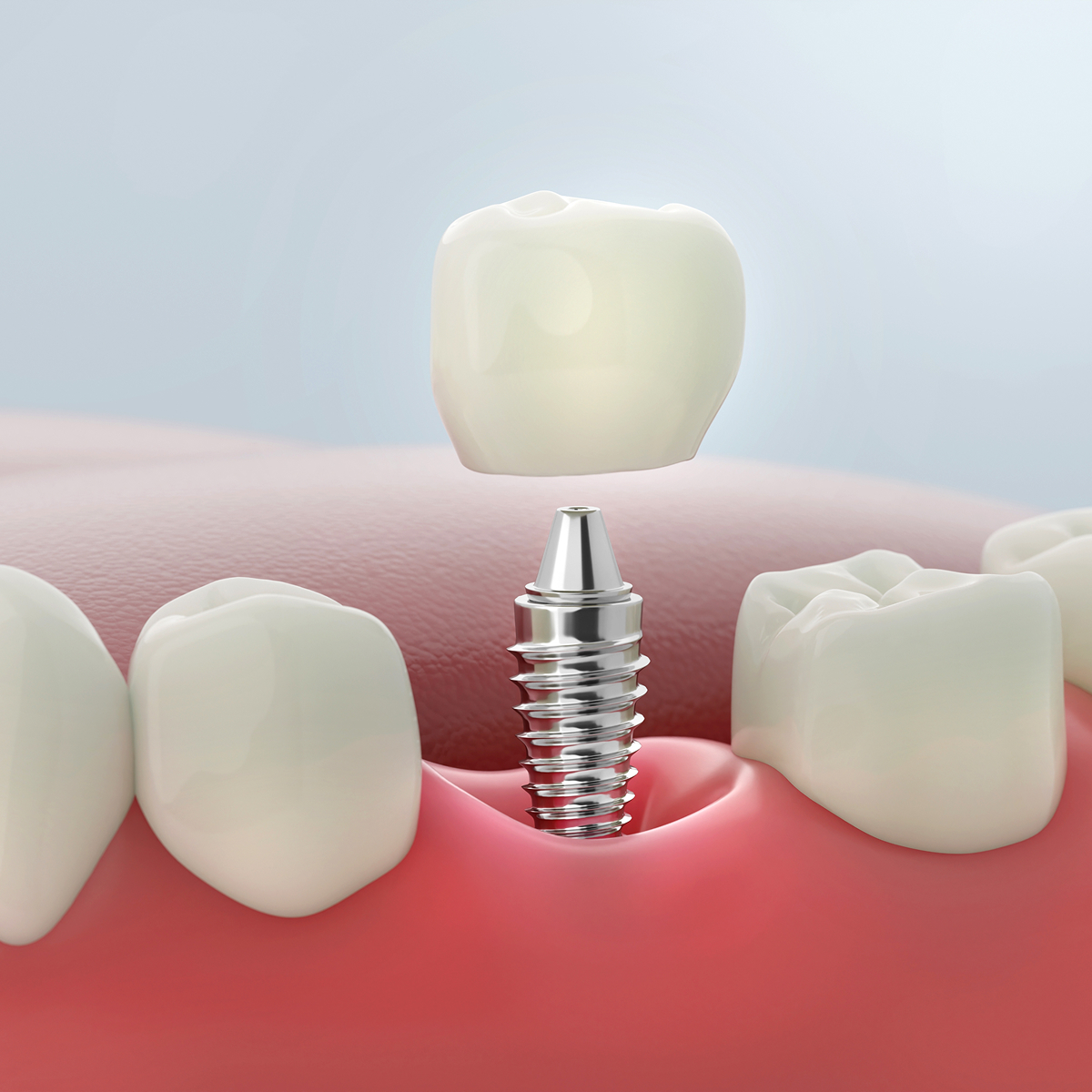 dental implant