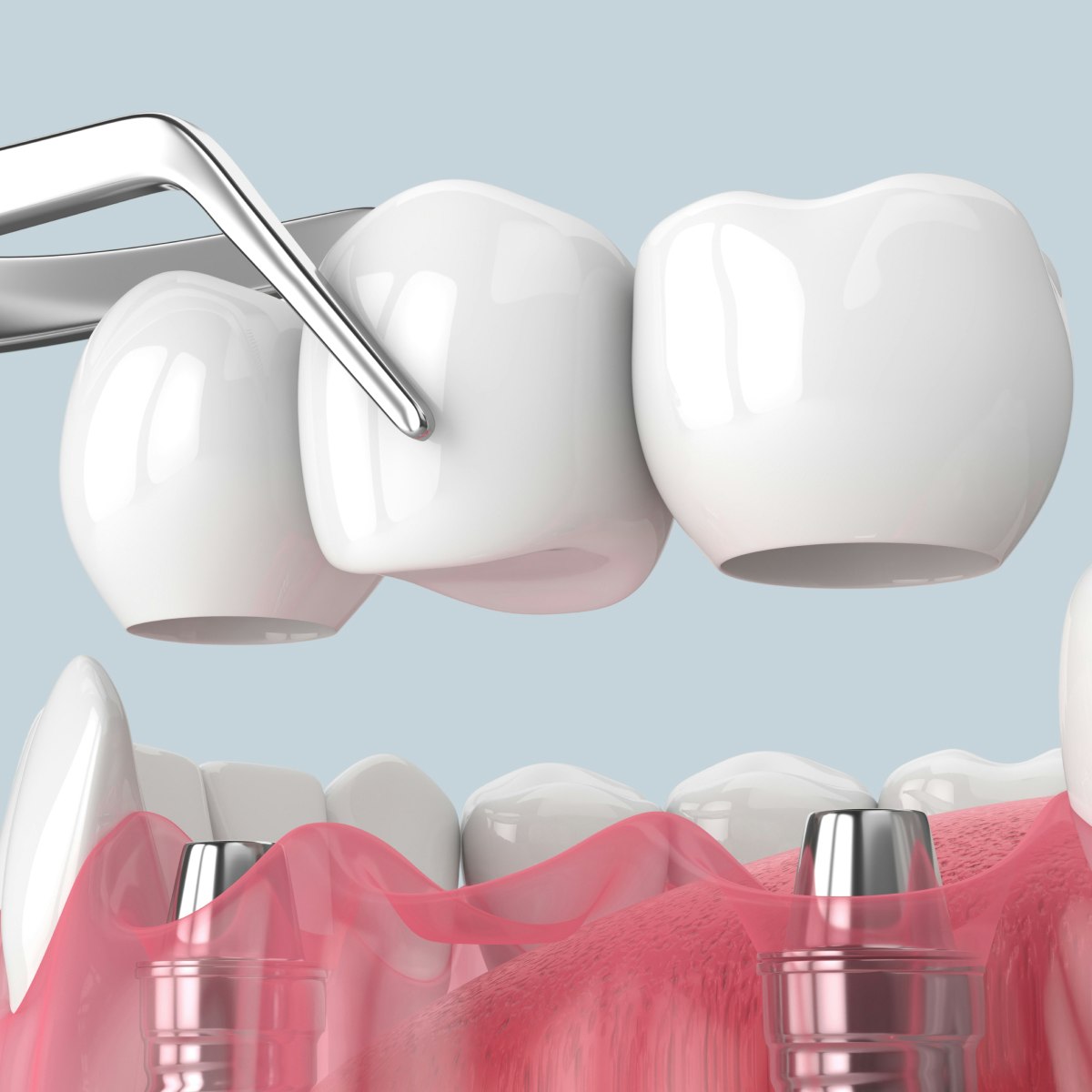 Dental Bridges