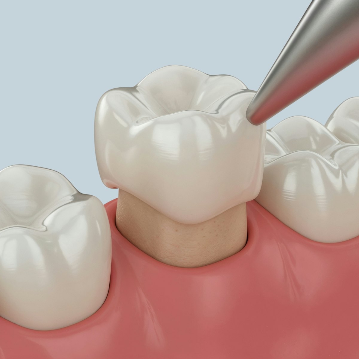 dental crown