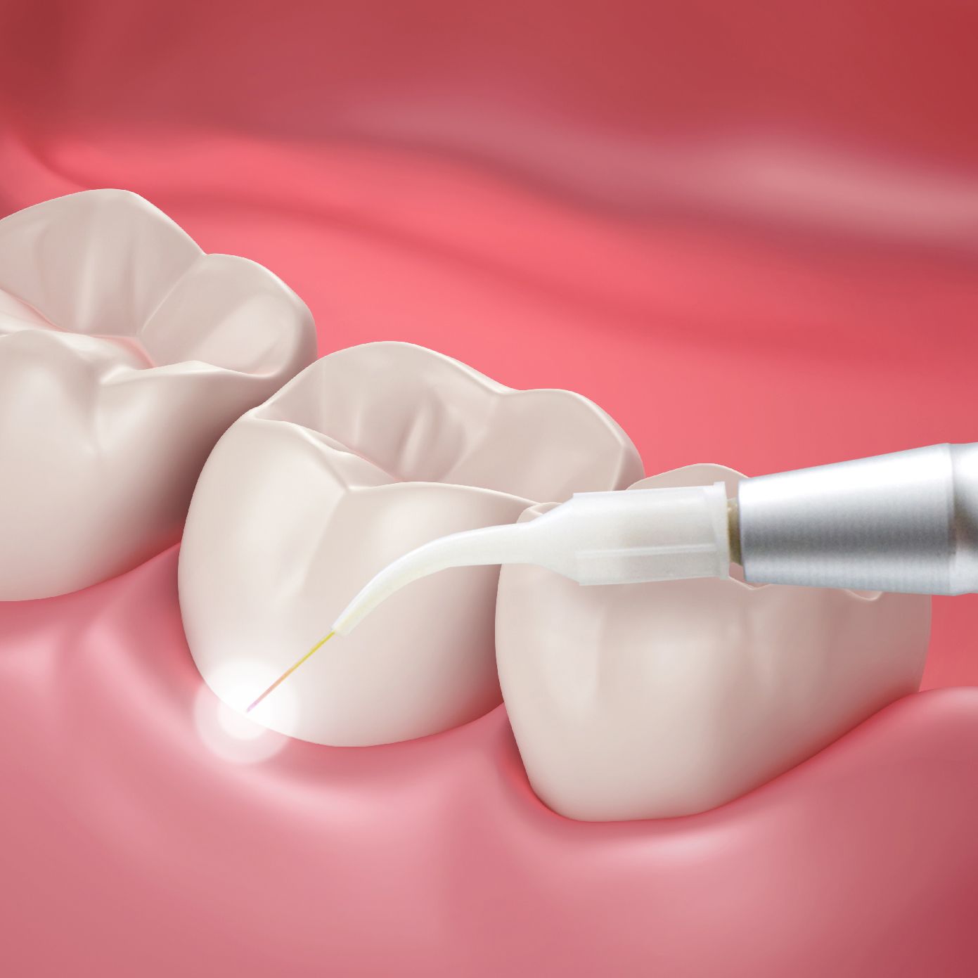Periodontal Treatment