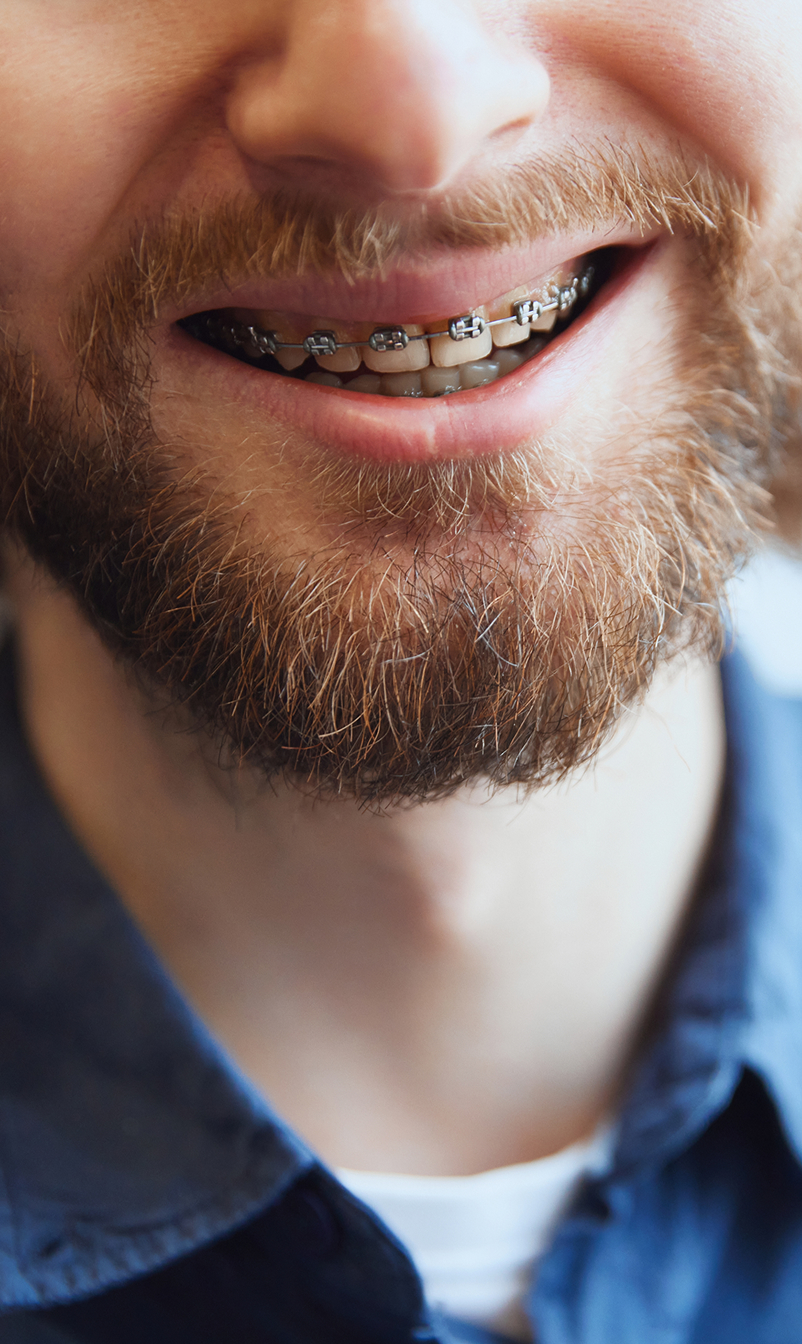 man with braces