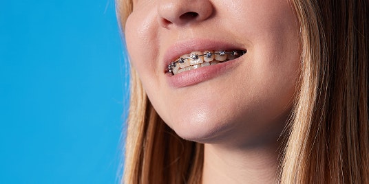 closeup of mouth with braces