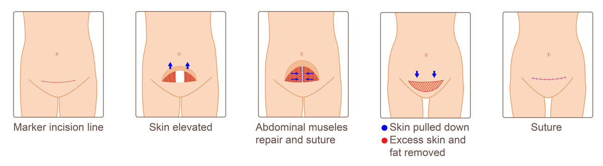Illustration showing the incisions for a mini tummy tuck