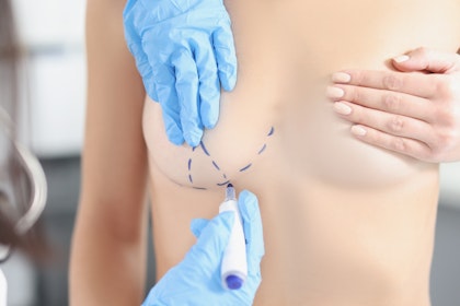 Breast lift incisions being marked