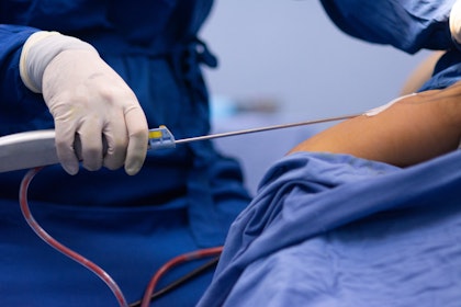 Liposuction cannula being used on patient during procedure