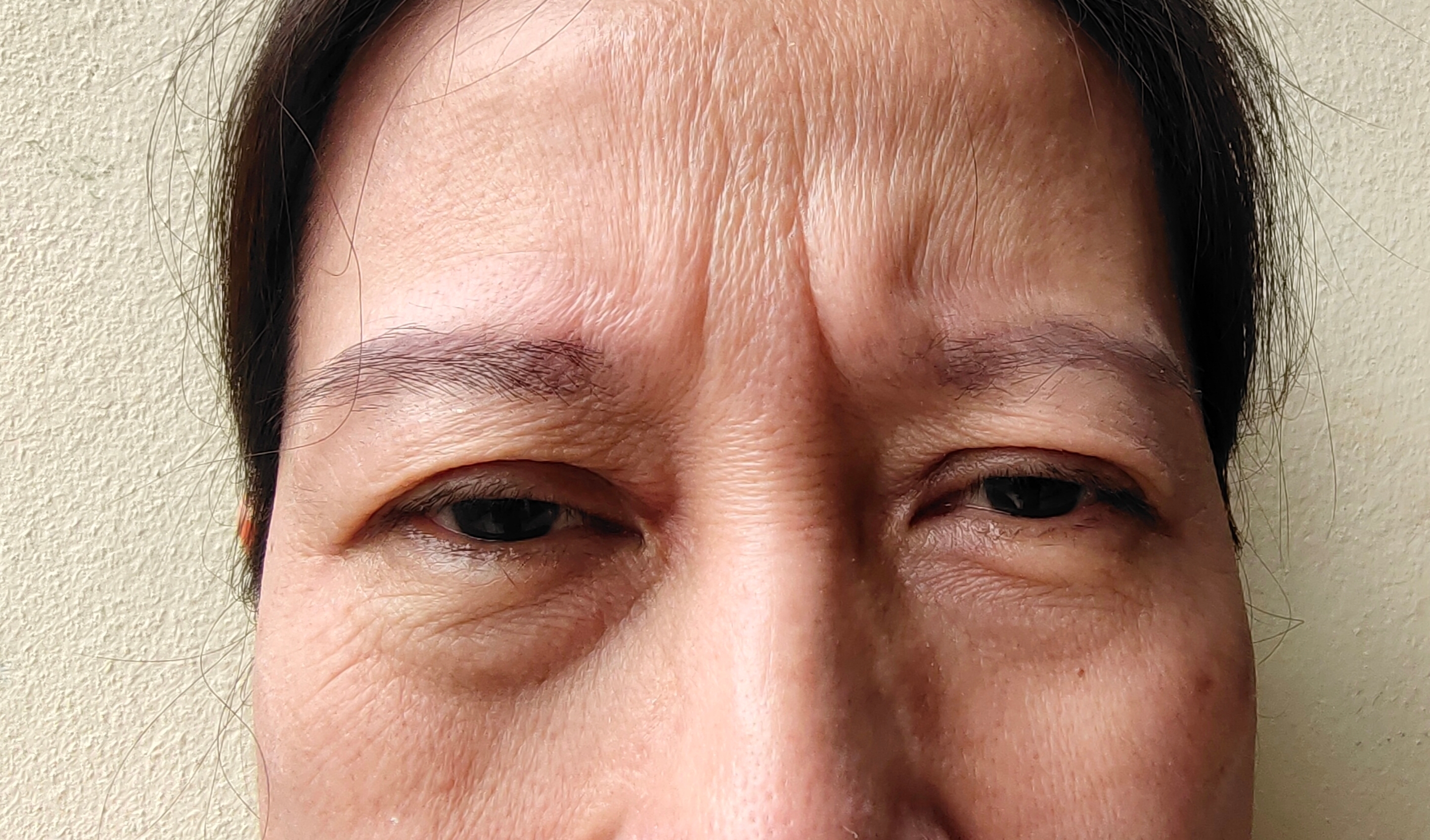 Deep Creases Under the Eyes