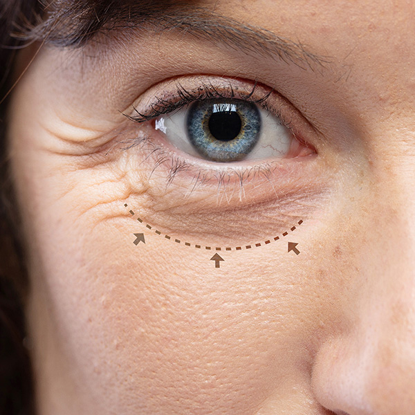 Blepharoplasty incision lines under woman's eye