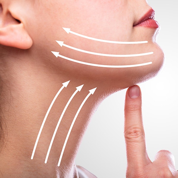 Lines indicating neck lift surgery