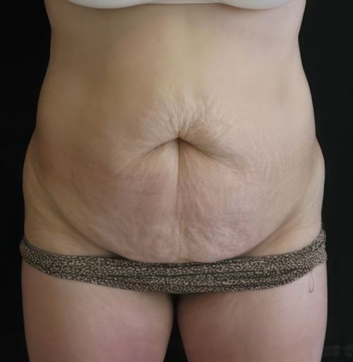 before tummy tuck