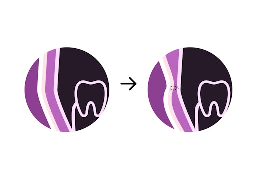 Dimpleplasty procedure of before and after with dissolvable suture in cheek next to a tooth