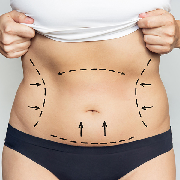Areas of liposuction marked on stomach