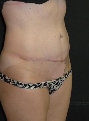 Our Houston patient after lipo and abdominoplasty