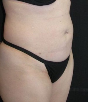 Our Houston patient before lipo and abdominoplasty