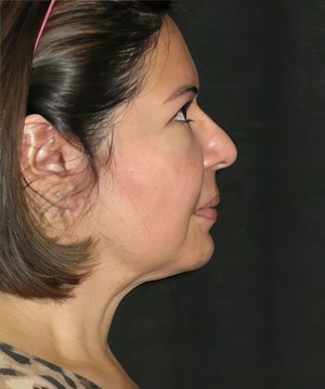 Our Houston patient after a neck lift