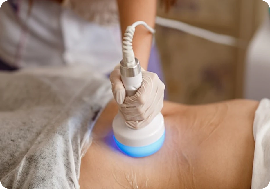 woman getting VASER laser treatment